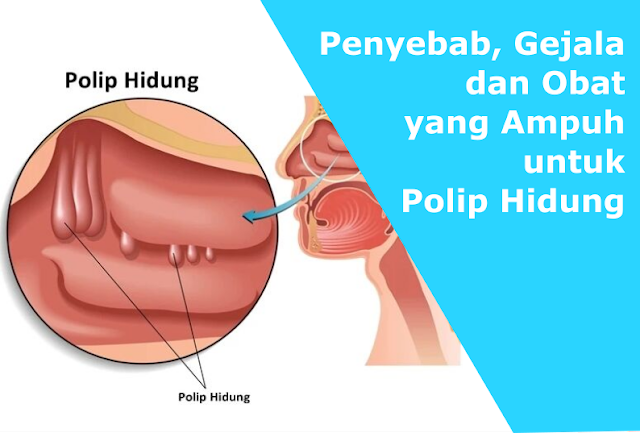Penyebab, Gejala dan Obat yang Ampuh untuk Polip Hidung Penyebab, Gejala dan Obat yang Ampuh untuk Polip Hidung